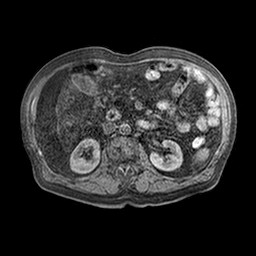 Cirrhosis and hepatocellular carcinoma in the setting of hemochromatosis (Radiopaedia 75394-86594 Axial T1 C+ fat sat 17).jpg