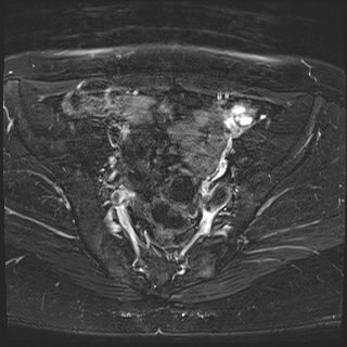 File:Class II Mullerian duct anomaly- unicornuate uterus with rudimentary horn and non-communicating cavity (Radiopaedia 39441-41755 Axial T2 fat sat 11).jpg