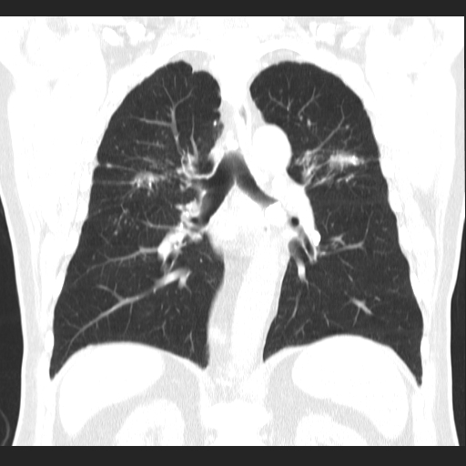 File:Classic complicated silicosis (Radiopaedia 49720-54961 Coronal lung window 39).jpg