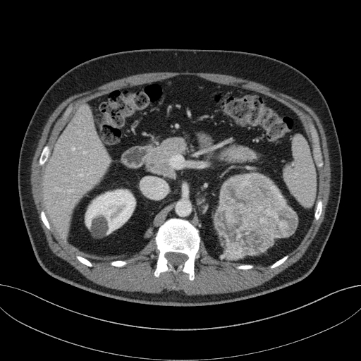 File:Clear cell renal cell carcinoma (Radiopaedia 61449-69393 E 23).jpg