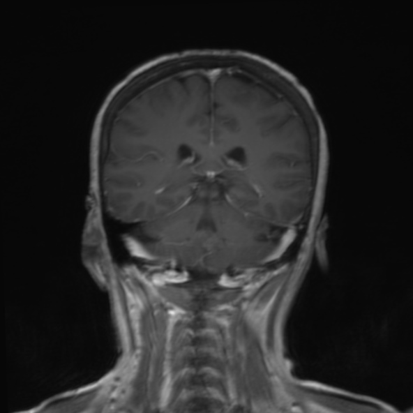 File:Clival meningioma (Radiopaedia 53278-59248 F 19).jpg