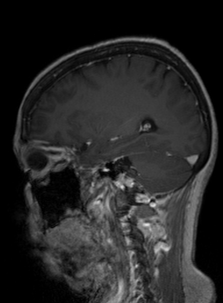 Clival meningioma (Radiopaedia 53278-59248 Sagittal T1 C+ 208).jpg