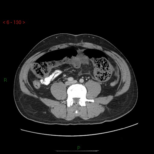 Closed loop obstruction and appendicular stump mucocele (Radiopaedia 54014-60163 A 75).jpg