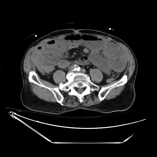 Closed loop obstruction due to adhesive band, resulting in small bowel ischemia and resection (Radiopaedia 83835-99023 Axial non-contrast 100).jpg