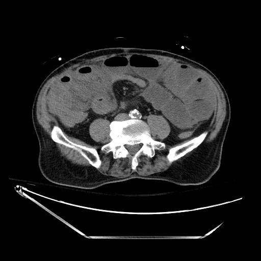 Closed loop obstruction due to adhesive band, resulting in small bowel ischemia and resection (Radiopaedia 83835-99023 Axial non-contrast 96).jpg