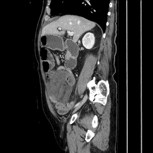 File:Closed loop obstruction due to adhesive band, resulting in small bowel ischemia and resection (Radiopaedia 83835-99023 F 74).jpg