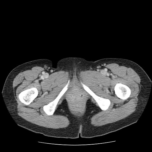File:Closed loop small bowel obstruction (Radiopaedia 65403-74451 Axial 76).jpg