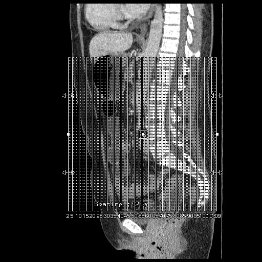 Closed loop small bowel obstruction (Radiopaedia 65403-74451 B 1).jpg