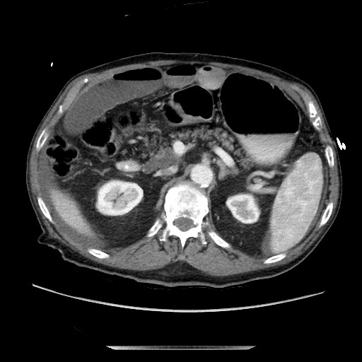 Closed loop small bowel obstruction - adhesive disease and hemorrhagic ischemia (Radiopaedia 86831-102990 A 71).jpg
