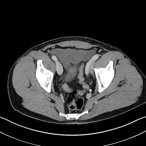 File:Closed loop small bowel obstruction - internal hernia (Radiopaedia 57806-64778 B 111).jpg