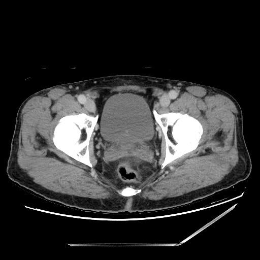Closed loop small bowel obstruction - omental adhesion causing "internal hernia" (Radiopaedia 85129-100682 A 159).jpg