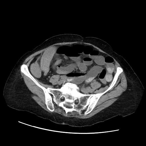 Closed loop small bowel obstruction due to adhesive band, with intramural hemorrhage and ischemia (Radiopaedia 83831-99017 Axial non-contrast 112).jpg