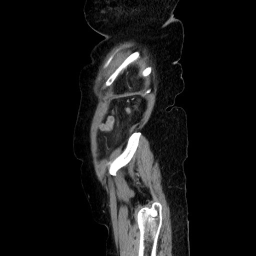 Closed loop small bowel obstruction due to adhesive band, with intramural hemorrhage and ischemia (Radiopaedia 83831-99017 D 165).jpg