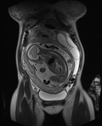 File:Closed loop small bowel obstruction in pregnancy (MRI) (Radiopaedia 87637-104031 Coronal T2 19).jpg