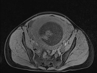 Closed loop small bowel obstruction in pregnancy (MRI) (Radiopaedia 87637-104031 F 44).jpg