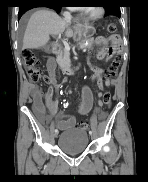 Closed loop small bowel obstruction with ischemia (Radiopaedia 84180-99456 B 37).jpg