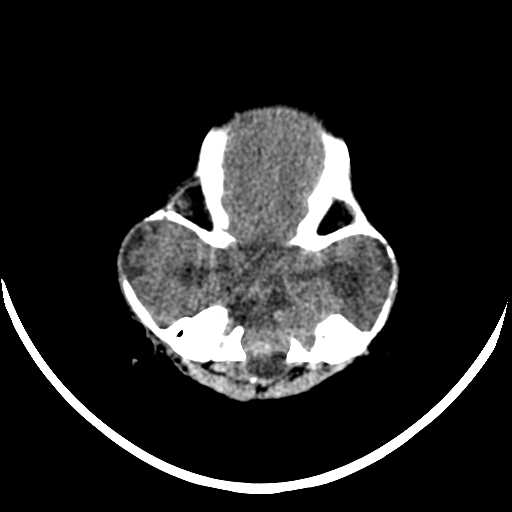 File:Cloverleaf shaped skull in the absence of craniosynostosis (Radiopaedia 21296-21216 Axial non-contrast 3).jpg