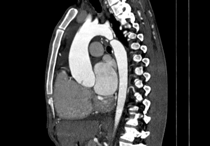 Coarctation of aorta with aortic valve stenosis (Radiopaedia 70463-80574 B 72).jpg