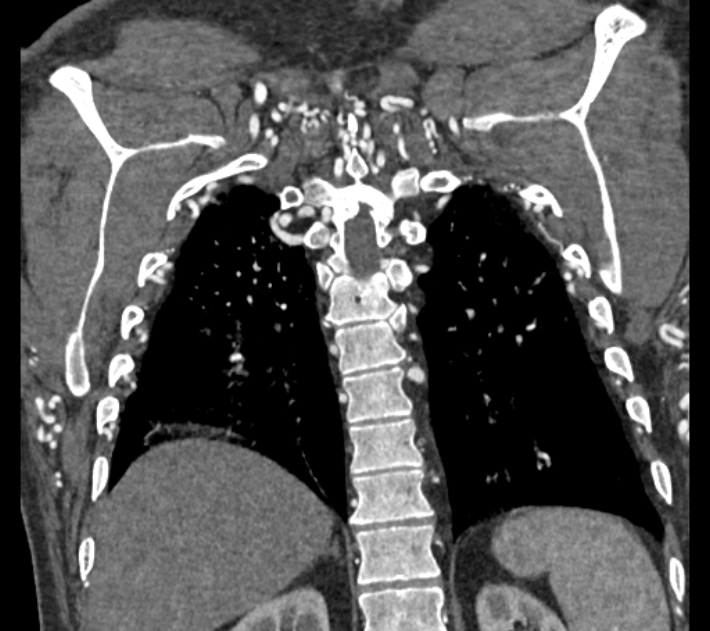 Coarctation of the aorta (Radiopaedia 53752-59822 B 64).jpg