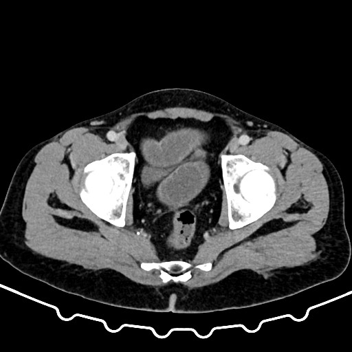 Colocolic intussusception due to large lipoma (Radiopaedia 68773-78482 A 176).jpg