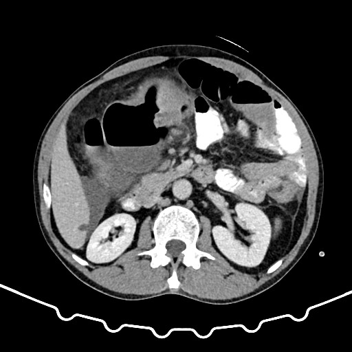 File:Colocolic intussusception due to large lipoma (Radiopaedia 68773-78482 A 71).jpg