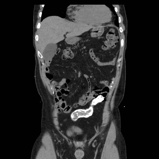 File:Colocutaneous fistula in Crohn's disease (Radiopaedia 29586-30093 E 6).jpg