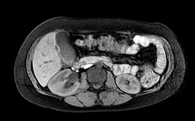 Colon adenocarcinoma with Krukenberg tumors, advanced pregnancy (Radiopaedia 67279-76645 A 51).jpg