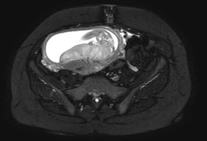 Colon adenocarcinoma with Krukenberg tumors, advanced pregnancy (Radiopaedia 67279-76645 Axial T2 SPAIR 25).jpg