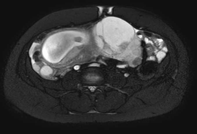 Colon adenocarcinoma with Krukenberg tumors, advanced pregnancy (Radiopaedia 67279-76645 Axial T2 SPAIR 34).jpg