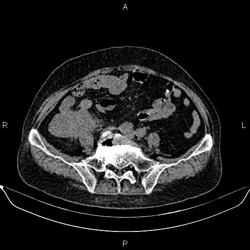 File:Colon cancer (Radiopaedia 90215-107432 Axial non-contrast 63).jpg