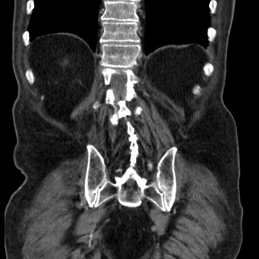 File:Colon cancer with duodenal invasion (Radiopaedia 16278-15958 B 49).jpg