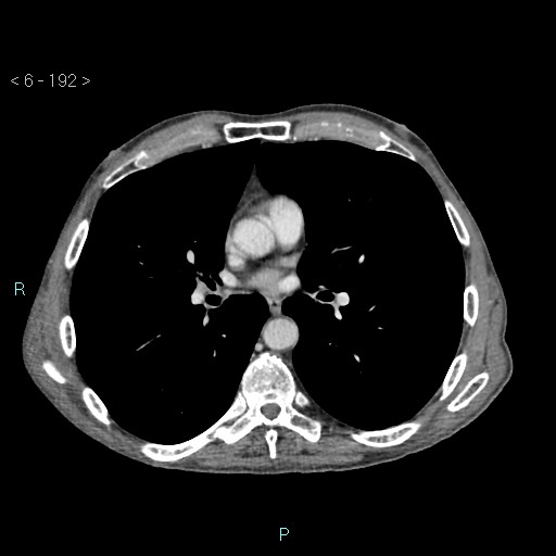 Colonic cancer (ultrasound and TC imaging) (Radiopaedia 50346-55713 B 192).jpg