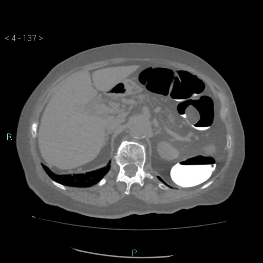 Colonic lipomas (Radiopaedia 49137-54244 Axial bone window 61).jpg
