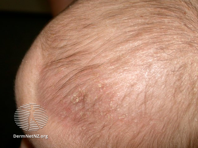 File:Cradle cap (DermNet NZ dermatitis-cradlecap3).jpg