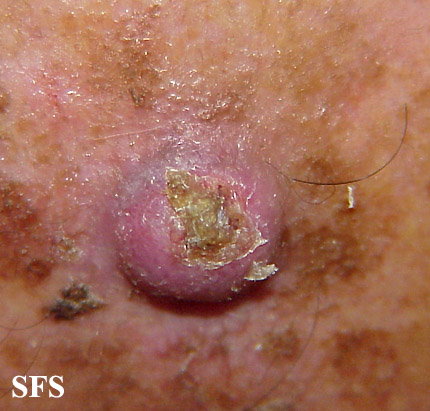 File:Keratoacanthoma (Dermatology Atlas 40).jpg