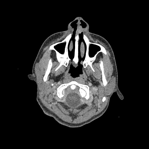 Nasal pyogenic granuloma (lobular capillary hemangioma) (Radiopaedia 85536-101244 C 14).jpg