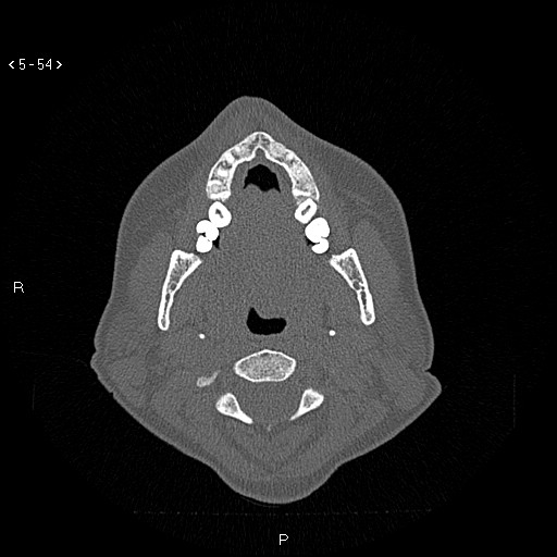 Nasolabial cyst (Radiopaedia 75125-86194 Axial bone window 15).jpg