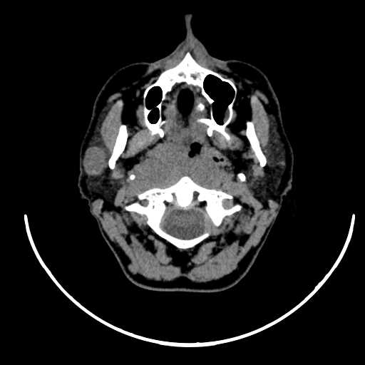 File:Nasopharyngeal carcinoma - infiltrating the clivus (Radiopaedia 62583-70875 Axial non-contrast 21).jpg