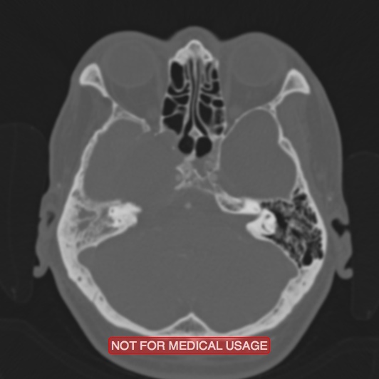 File:Nasopharyngeal carcinoma recurrence - skull base destruction (Radiopaedia 29107-29490 Axial bone window 79).jpg