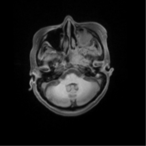 File:Nasopharyngeal carcinoma with cerebral abscess (Radiopaedia 43018-46274 Axial T1 fat sat 14).png