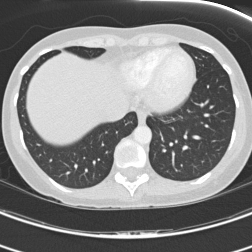 File:Necrobiotic pulmonary nodules - Crohn disease (Radiopaedia 20723-20631 Axial lung window 111).jpg