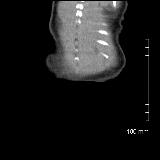 File:Neonatal neuroblastoma (Radiopaedia 56651-63438 Coronal non-contrast 47).jpg