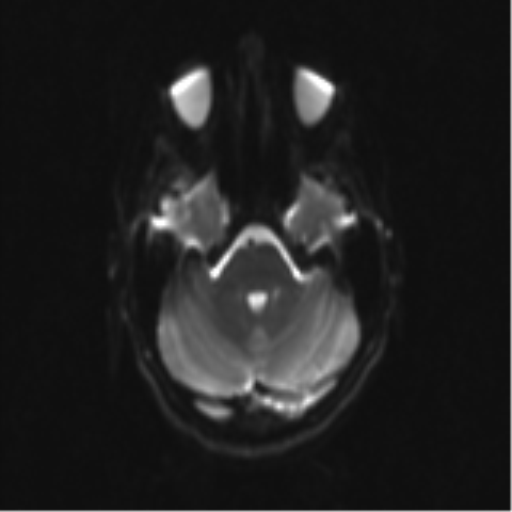 Neurenteric cyst (Radiopaedia 58641-65837 Axial DWI 11).png