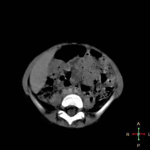 File:Neuroblastoma (Radiopaedia 24751-25016 D 27).jpg