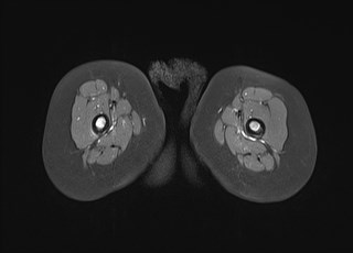 File:Neuroblastoma with bone metastases (Radiopaedia 67080-76414 Axial T1 C+ fat sat 33).jpg