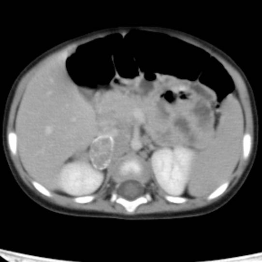 Neuroblastoma with skull metastases (Radiopaedia 30326-30960 C 20).jpg