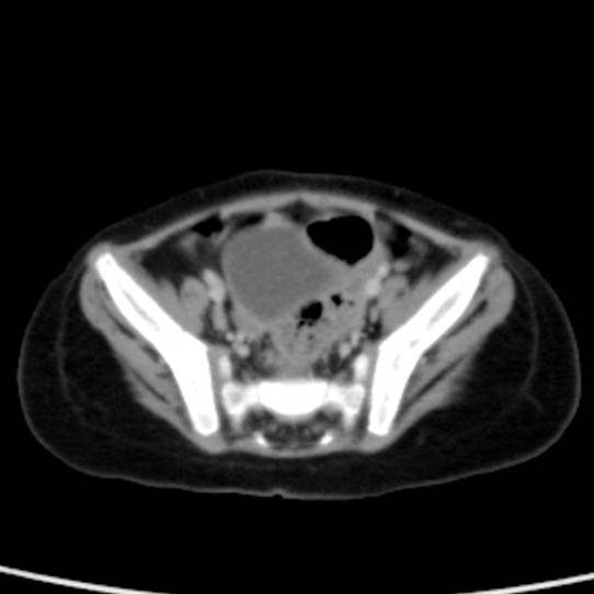 Neuroblastoma with skull metastases (Radiopaedia 30326-30960 C 50).jpg