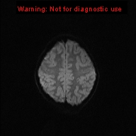 File:Neurofibromatosis type 1 with optic nerve glioma (Radiopaedia 16288-15965 Axial DWI 29).jpg
