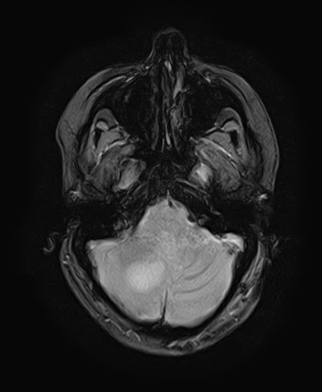 File:Neurofibromatosis type 2 (Radiopaedia 66211-75401 Axial Gradient Echo 9).jpg