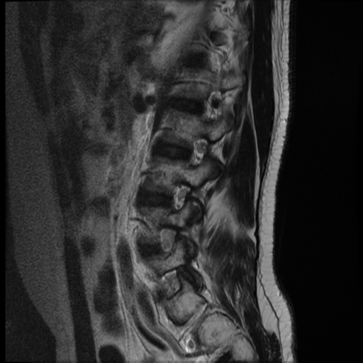 File:Neurofibromatosis type 2 (spinal manifestations) (Radiopaedia 53943-60070 E 3).png